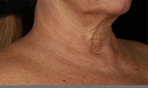 SkinMedica® Neck Correct Neck and Décolleté Cream 1.7 Oz. / 50 ml