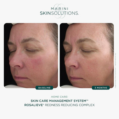 Marini Skin Solutions RosaLieve Redness Reducing Complex