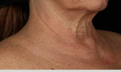 SkinMedica® Neck Correct Neck and Décolleté Cream 1.7 Oz. / 50 ml