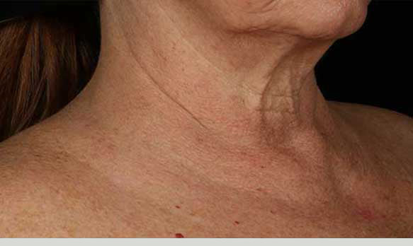 SkinMedica® Neck Correct Neck and Décolleté Cream 1.7 Oz. / 50 ml