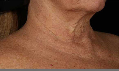 SkinMedica® Neck Correct Neck and Décolleté Cream 1.7 Oz. / 50 ml